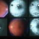 Choroiditis Choroiditis
